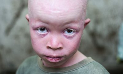 Skin cancer kills 3 persons with Albinism in Anambra in five months -Group