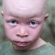 Skin cancer kills 3 persons with Albinism in Anambra in five months -Group